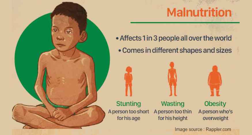 Malnutrition Meaning Causes And Prevention In Hindi Tfipost in