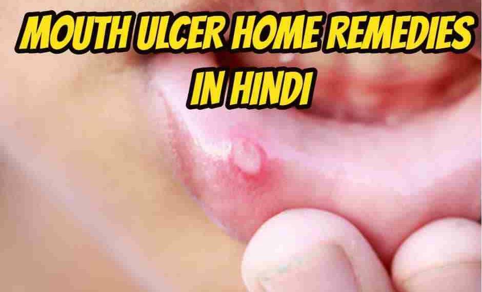 Ulcer  meaning in hindi