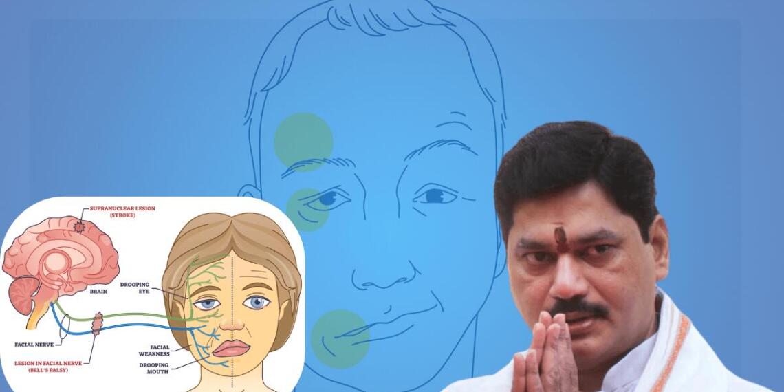 इस बीमारी में चेहरे की एक तरफ की मांसपेशियों में अचानक कमज़ोरी आ जाती है या लकवे जैसी स्थिति हो जाती है